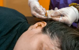 Read more about the article FUE vs FUT Hair Transplant in Malaysia: Which Technique Is Best for Your Hair Loss?
