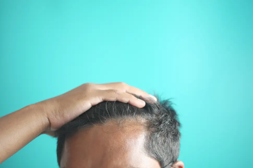 Read more about the article Why Are So Many Malaysians Losing Hair in Their 30s? Causes, Early Warning Signs & Hair Restoration Solutions in Malaysia