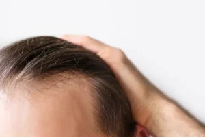 Read more about the article Can Hair Loss Treatment Help Men with Male Pattern Baldness Naturally?