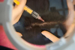 Read more about the article Diagnosis of Hair Loss in Malaysia: Signs, Tests & Treatment Guide